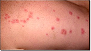 Bed Bug Bites - Ohio & Kentucky